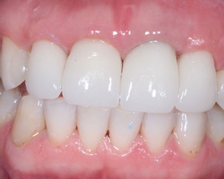 Что такое зубные коронки, зачем и как устанавливают зубные коронки