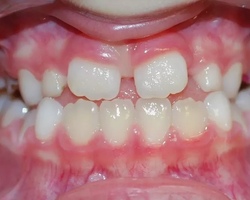 Как Прорезываются Зубы Фото