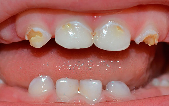 Почему важно сохранять молочные зубы?