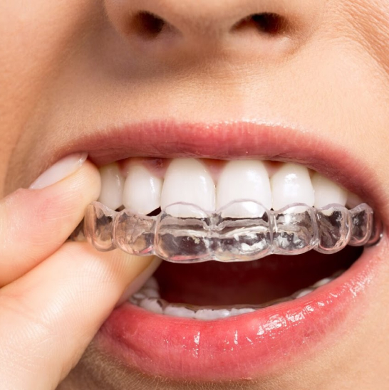 Элайнеры для выравнивания зубов (ортодонтические каппы)