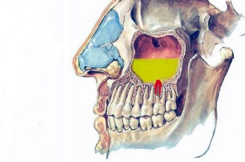 Одонтогенный гайморит. Верхнечелюстная гайморова пазуха. Одонтогенный верхнечелюстной синусит. Одонтогенное воспаление верхнечелюстной пазухи. Одонтогенный верхний челюстной синусит.